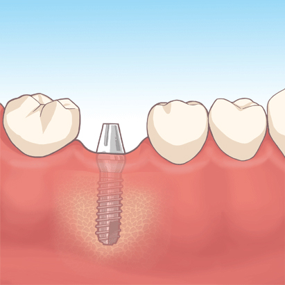 インプラント治療の流れ